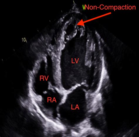 left ventricular noncompaction prognosis